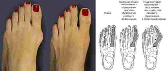 Как вылечить косточку на ноге Деформация косточки большого пальца на ноге имеет медицинское название…